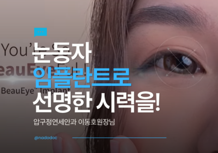 눈동자 임플란트, 아이링수술