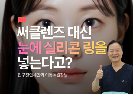 써클렌즈 대신에 실리콘 링 삽입, 아이링수술