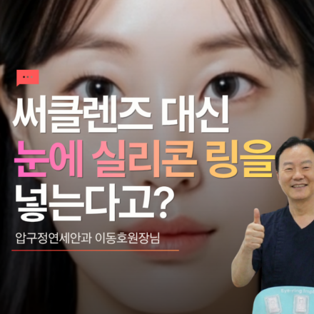 써클렌즈 대신에 실리콘 링 삽입, 아이링수술